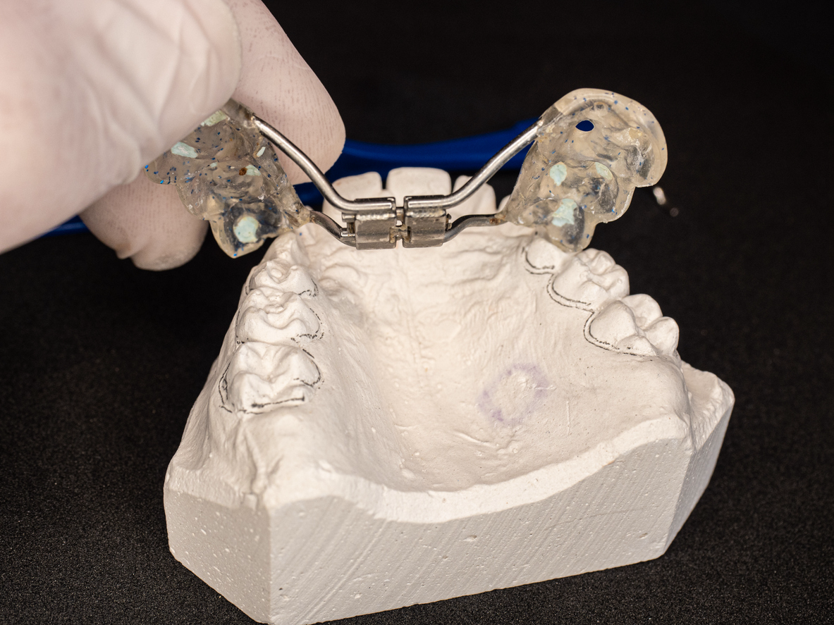 A dental expander held next to an impression of a patient's upper arch of teeth.